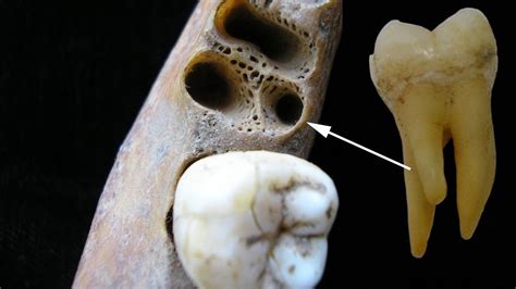 first molar teeth root